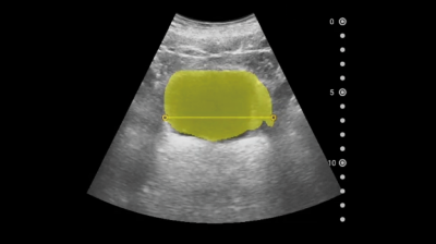 膀胱尿量計測 のイメージ
