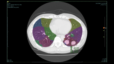 肺区域ラベル・肺結節検出機能・肺結節性状分析機能のイメージ