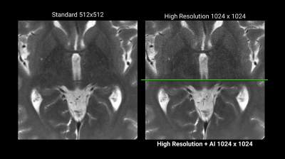MRIノイズ除去技術のイメージ