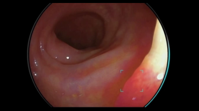 大腸ポリープの検出と鑑別支援技術のイメージ
